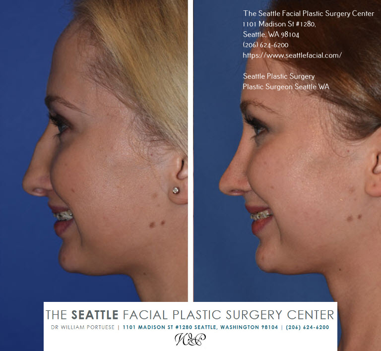 the seattle rhinoplasty center